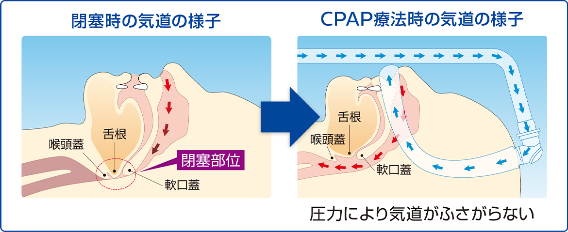 閉塞時の気道の様子→CPAP療法時の気道の様子