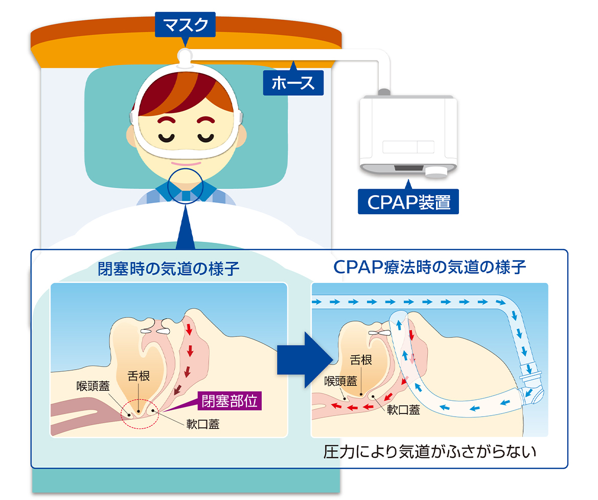 CPAP装置　閉塞時の気道の様子→CPAP療法時の気道の様子
